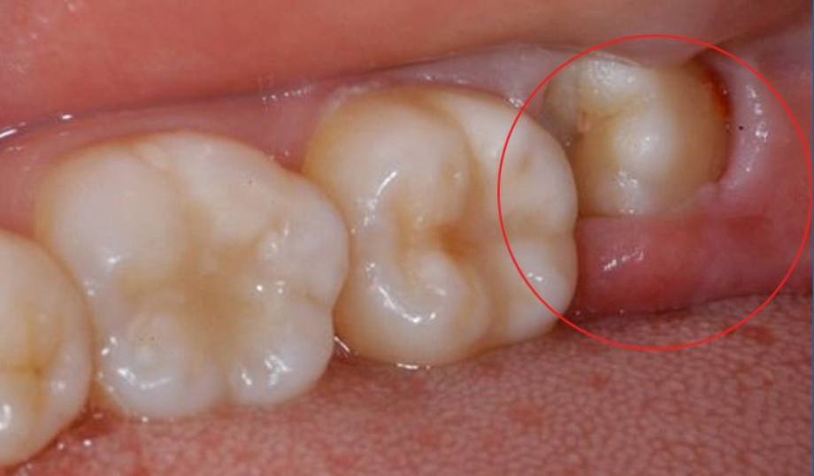 Hình ảnh răng 8 mọc lệch đâm vào răng 7